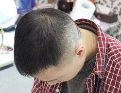 -大麦微针植发全国连锁