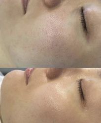 -苑苑vbeauty科技美容SPA