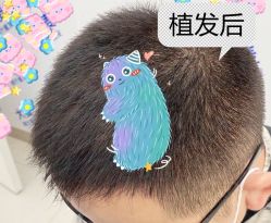 -大麦微针植发全国连锁