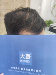 -大麦微针植发丨全国连锁