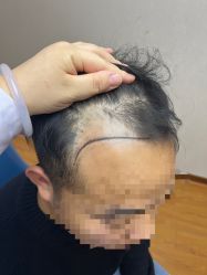 -大麦微针植发全国连锁