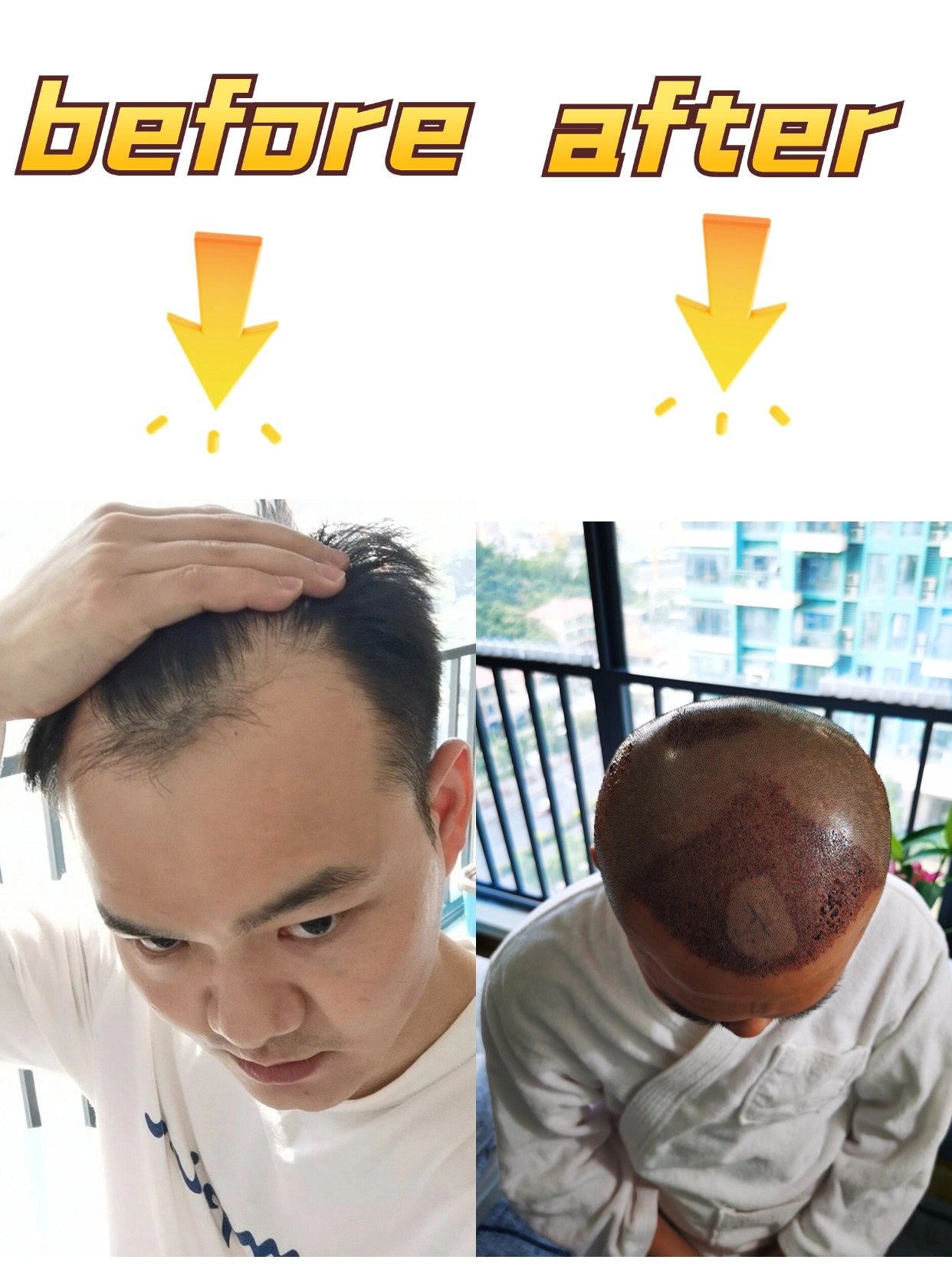 冬天做完植发手术(冬天做完植发手术注意什么)