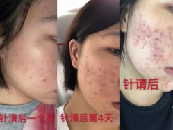 -苗方清颜痘肌研究所