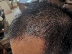 -碧莲盛·不剃发植发