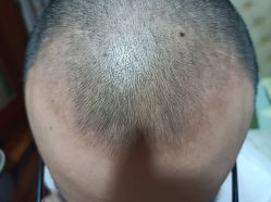 -大麦微针植发丨全国连锁