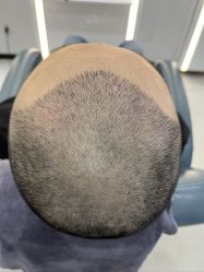 体验后-大麦微针植发全国连锁