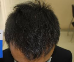 -大麦微针植发全国连锁