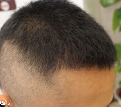 -大麦微针植发丨全国连锁