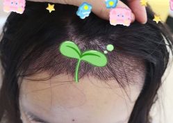 -大麦微针植发全国连锁