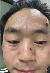 -北京美痣堂古方祛痣斑疣瘊
