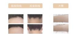 -HEYAN荷妍专业脱毛连锁机构
