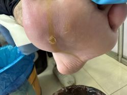 -德哥灰指甲脚气甲沟炎跖疣护理