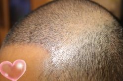 -大麦微针植发丨全国连锁