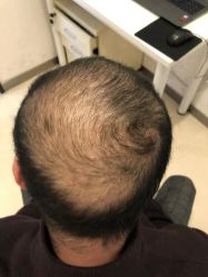 体验前-大麦微针植发丨全国连锁