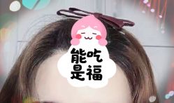 -大麦微针植发全国连锁