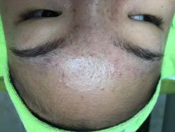 -苗医生草本科技祛痘