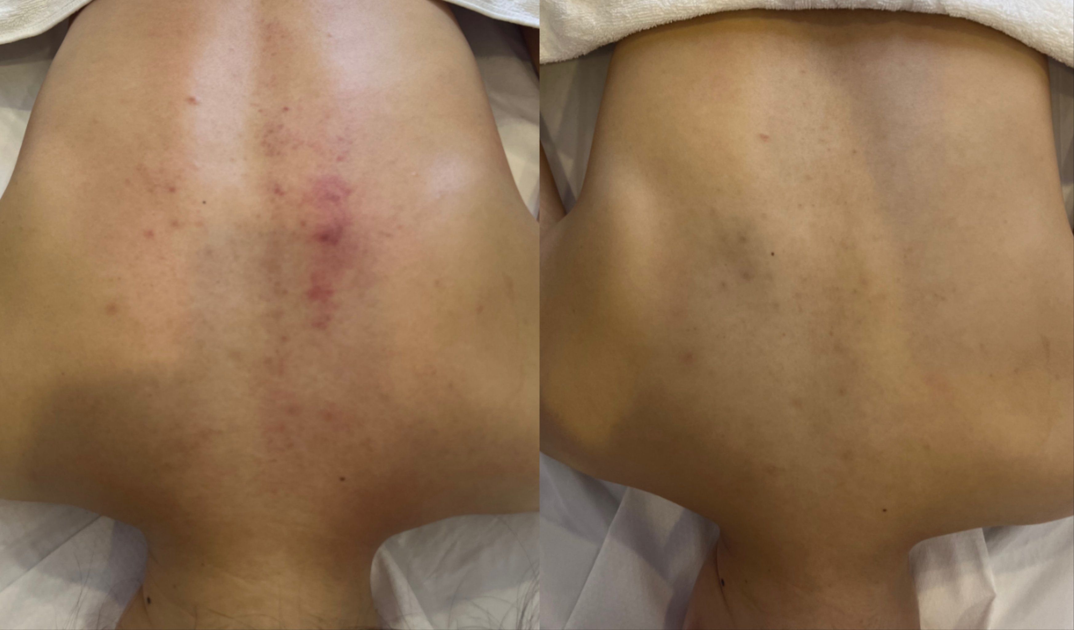 脊椎侧弯变形,高低肩对比