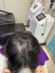 -碧莲盛·不剃发植发