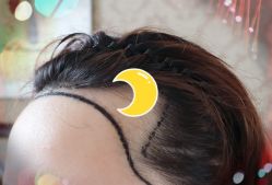 -大麦微针植发全国连锁