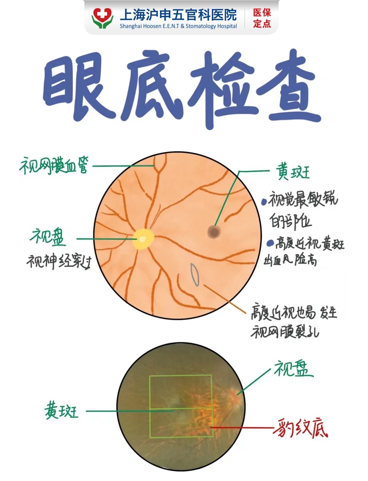 眼底检查至关重要