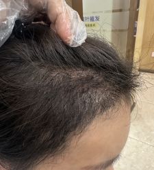 -大麦微针植发全国连锁