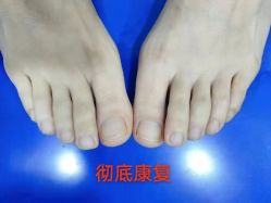 -德哥灰指甲脚气甲沟炎跖疣护理