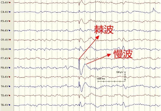 异常脑电图尖波尖慢波图片