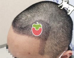 -大麦微针植发全国连锁