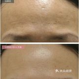 肌肤回春大法，纤维芽细胞培养回输公开！