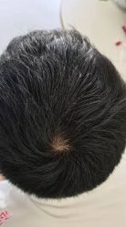 -大麦微针植发丨全国连锁