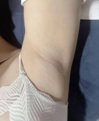 -薇兰专业脱毛连锁机构