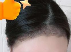 -大麦微针植发丨全国连锁