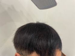 -碧莲盛·不剃发植发