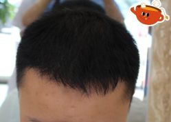 -大麦微针植发丨全国连锁