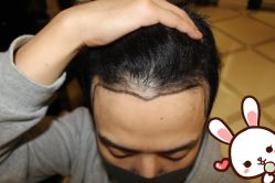 点击看大图 -大麦微针植发丨全国连锁