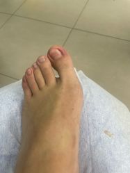 -德哥灰指甲脚气甲沟炎跖疣护理