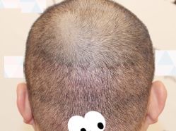 -大麦微针植发全国连锁