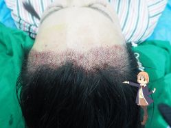 -大麦微针植发丨全国连锁