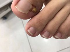 -世龙世家灰指甲·甲沟炎·跖疣护理·修脚(东江湾路店)