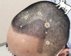 -大麦微针植发全国连锁