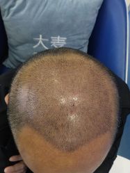 -大麦微针植发全国连锁