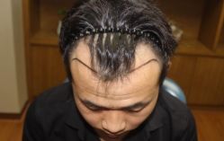 体验前-大麦微针植发全国连锁