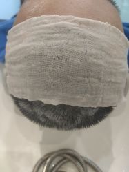 -碧莲盛·不剃发植发