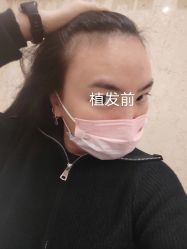 -碧莲盛·不剃发植发