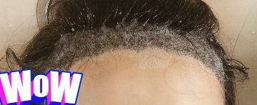 -大麦微针植发丨全国连锁