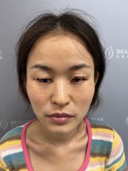 体验前-叶美人医疗美容