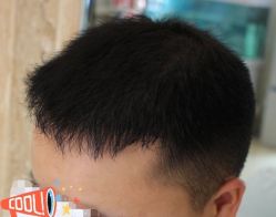 -大麦微针植发丨全国连锁