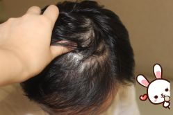 -大麦微针植发丨全国连锁