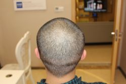 -大麦微针植发丨全国连锁