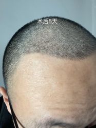 点击看大图 体验前-碧莲盛·不剃发植发
